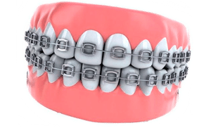 Ортодонтичні матеріали в Черкасах