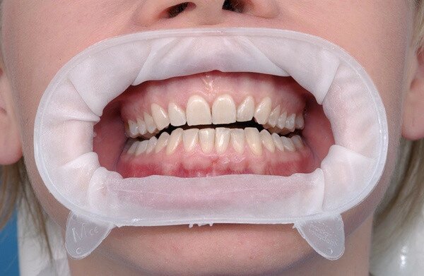 Оптагейт (оптагейт) втягувач губ і щок, набір 80 шт. від компанії Компанія "FreeDental" - фото 1