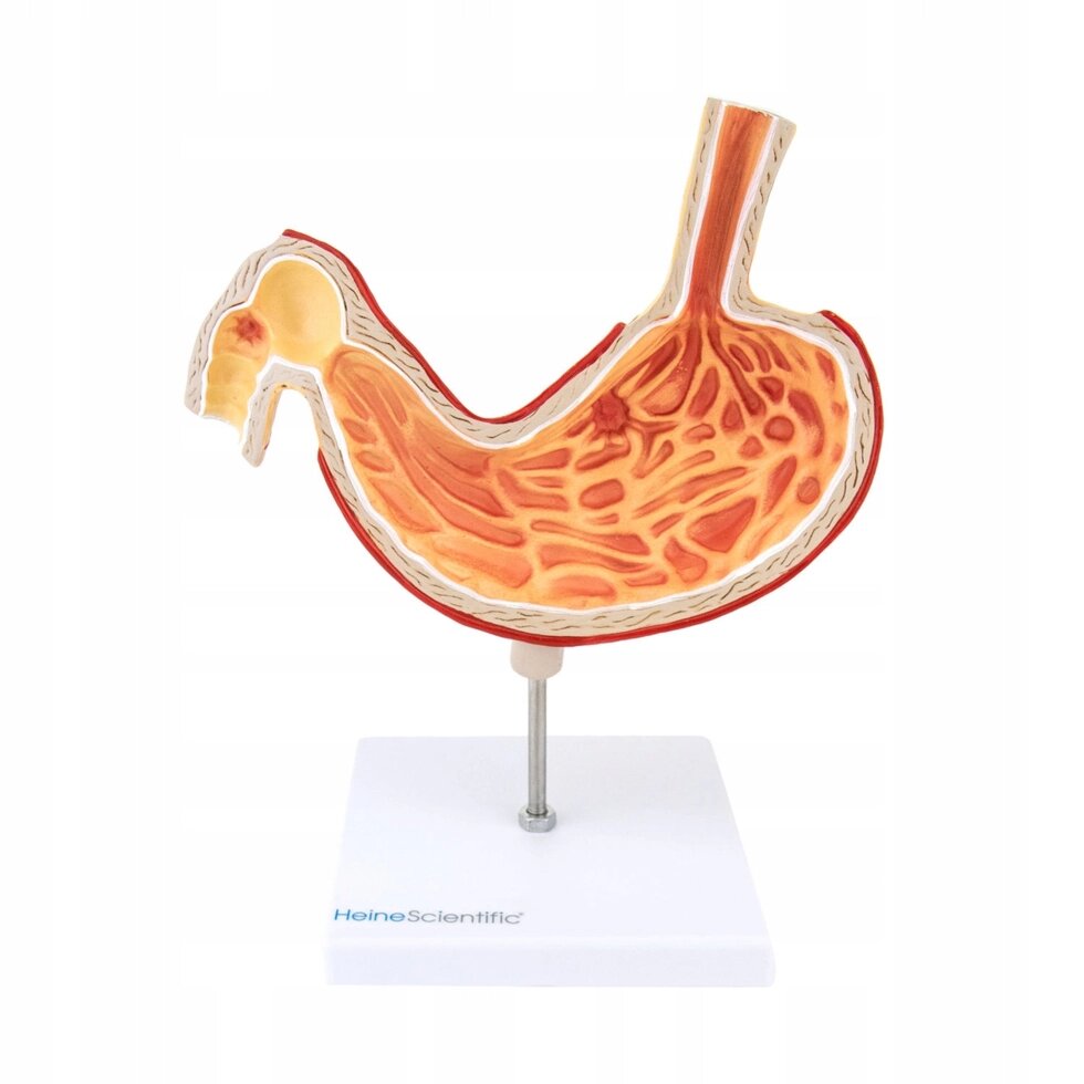 Анатомічна модель моделі шлунка з виразкою від компанії Euromarka - фото 1