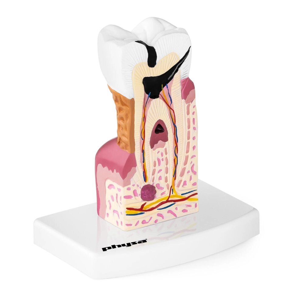 Хворий зуб - це анатомічна модель Physa (-)} від компанії Euromarka - фото 1