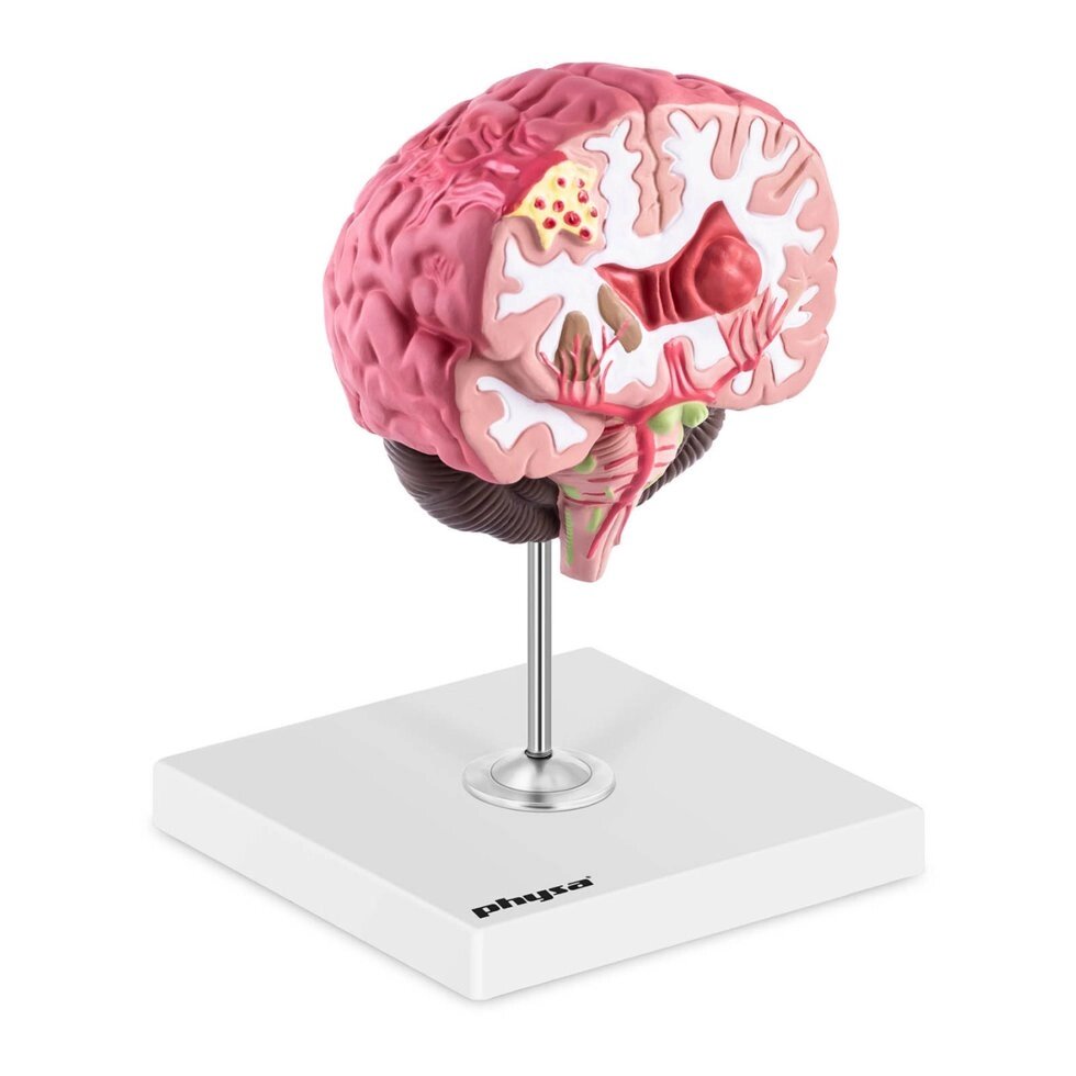 Мозок - Анатомічна модель - 3 патології Physa (-) від компанії Euromarka - фото 1