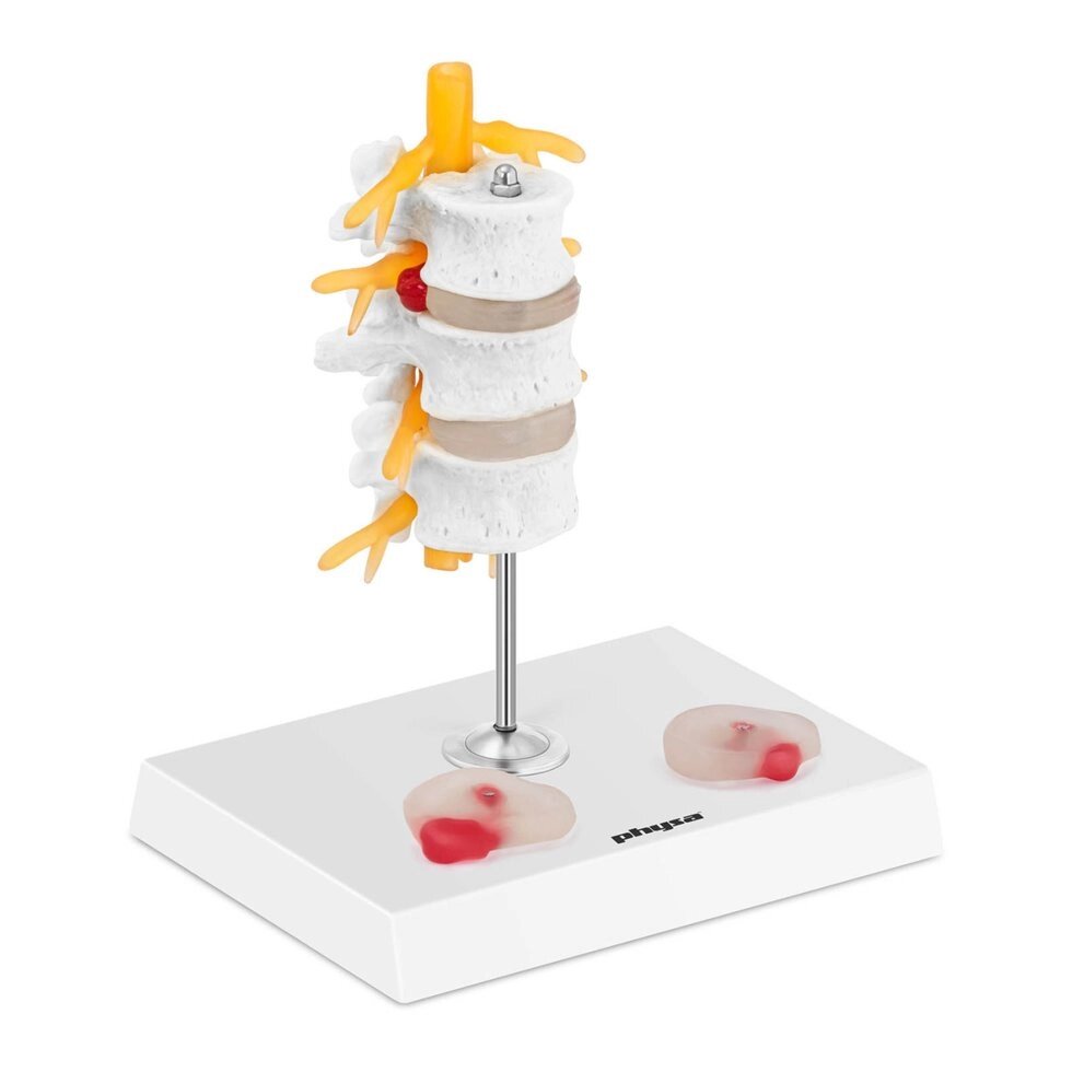 Поперекова область з грижею хребта - це анатомічна модель Physa (-) від компанії Euromarka - фото 1