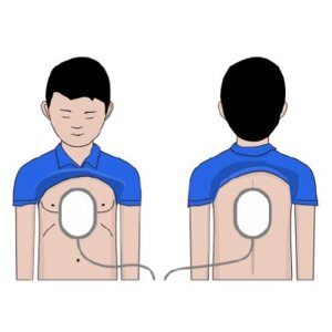 Електроди для дефібрилятора AED Amoul для дітей