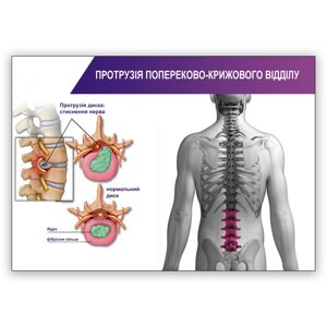 Плакат Протрузія попереково-крижового відділу Vivay А2