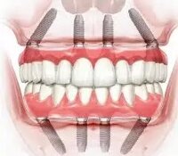 Neobiotech dental studio набір стоматологічні імпланти