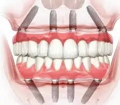Neobiotech dental studio набор стоматологические импланты