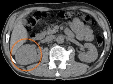Діагностика раку, онкології від компанії МРТ КТ Хмельницький Ультрадіагностіка - фото 1