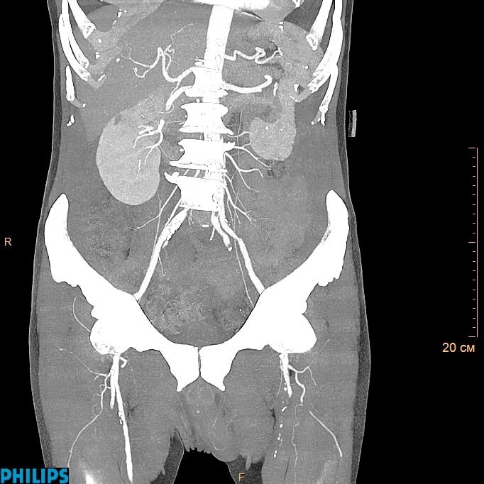 КТ-ангіографія аорти, черевної порожнини, тазу від компанії МРТ КТ Хмельницький Ультрадіагностіка - фото 1