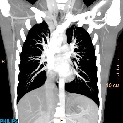 КТ-ангіографія легеневих артерій (ТЕЛА) зробити записатися пройти Хмельницький від компанії МРТ КТ Хмельницький Ультрадіагностіка - фото 1