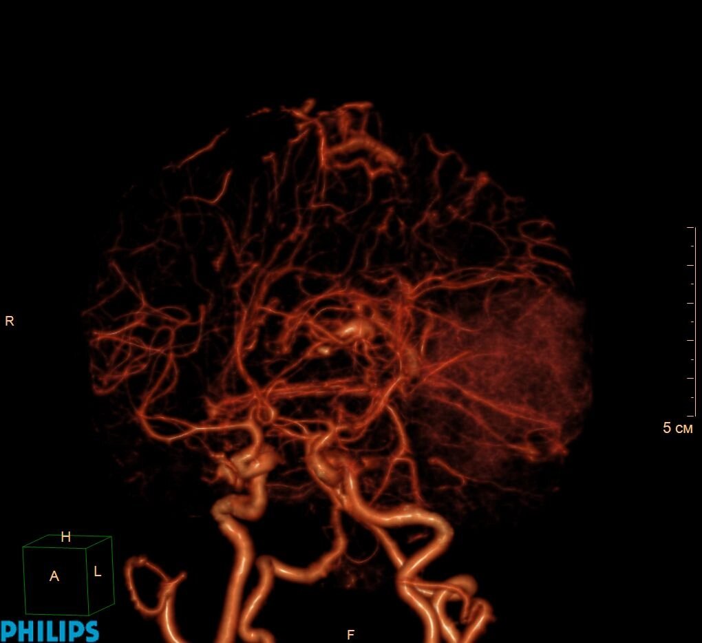 КТ-ангіографія судин головного мозку (голови) від компанії МРТ КТ Хмельницький Ультрадіагностіка - фото 1