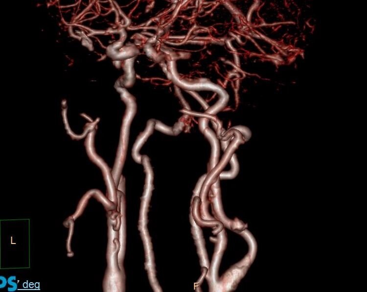 КТ-ангіографія судин шиї від компанії МРТ КТ Хмельницький Ультрадіагностіка - фото 1