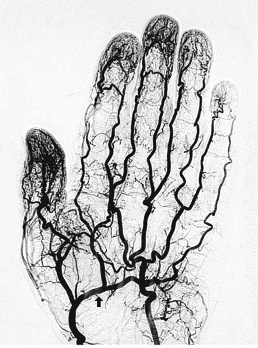 КТ-ангіографія верхніх кінцівок рук, руки від компанії МРТ КТ Хмельницький Ультрадіагностіка - фото 1