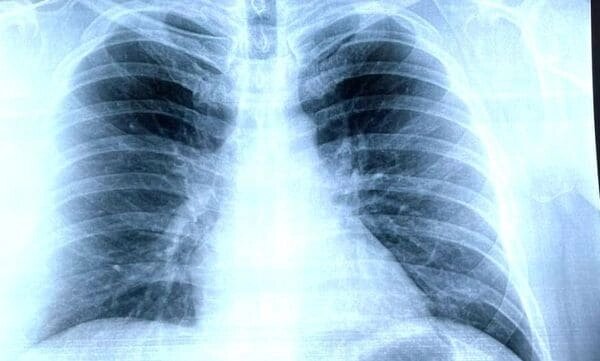 КТ діагностика пневмонії, запалення легенів діагностувати розпізнати ознаки при Коронавіруси ковіде Хмельницький від компанії МРТ КТ Хмельницький Ультрадіагностіка - фото 1