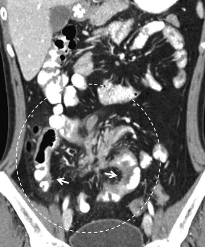 КТ-ентерографія обстеження кишечника (тонкого) від компанії МРТ КТ Хмельницький Ультрадіагностіка - фото 1