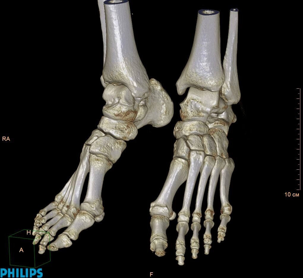 КТ гомілковостопних суглобів (гомілки, стопи) від компанії МРТ КТ Хмельницький Ультрадіагностіка - фото 1