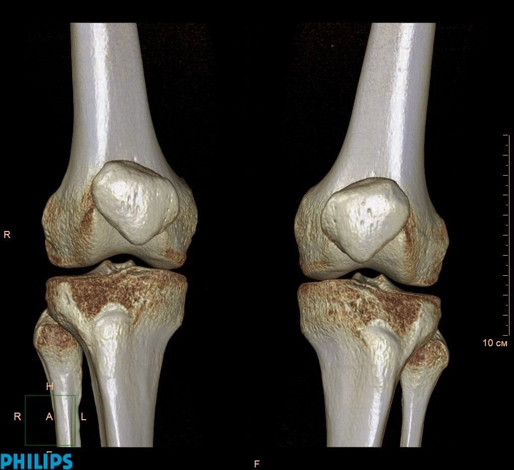 КТ колінних суглобів (коліна) від компанії МРТ КТ Хмельницький Ультрадіагностіка - фото 1
