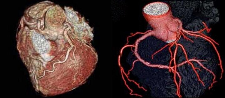 КТ коронарографія серця зробити записатися пройти Хмельницький від компанії МРТ КТ Хмельницький Ультрадіагностіка - фото 1