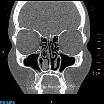 КТ навколоносових пазух і порожнини носа від компанії МРТ КТ Хмельницький Ультрадіагностіка - фото 1