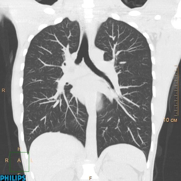 КТ органів грудної порожнини зробити записатися пройти Хмельницький від компанії МРТ КТ Хмельницький Ультрадіагностіка - фото 1