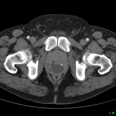 КТ передміхурової залози (простати) і насінних бульбашок від компанії МРТ КТ Хмельницький Ультрадіагностіка - фото 1