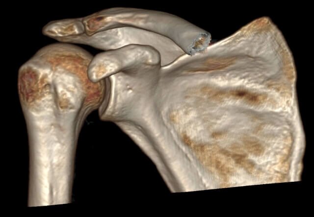 КТ плечових суглобів (плеча) від компанії МРТ КТ Хмельницький Ультрадіагностіка - фото 1