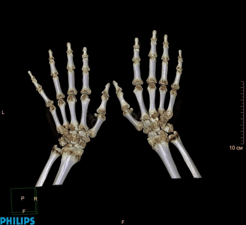 КТ променезап'ясткових суглобів (зап'ястя) від компанії МРТ КТ Хмельницький Ультрадіагностіка - фото 1