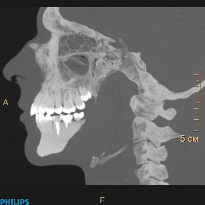 КТ щелепно-лицевої ділянки, щелепи, Дентальне зубів від компанії МРТ КТ Хмельницький Ультрадіагностіка - фото 1
