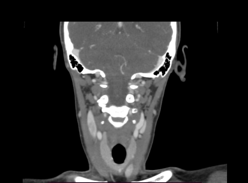 КТ шиї і м'яких тканин шиї (горла і гортані, слинних залоз, щитовидної залози, лімфовузлів) від компанії МРТ КТ Хмельницький Ультрадіагностіка - фото 1