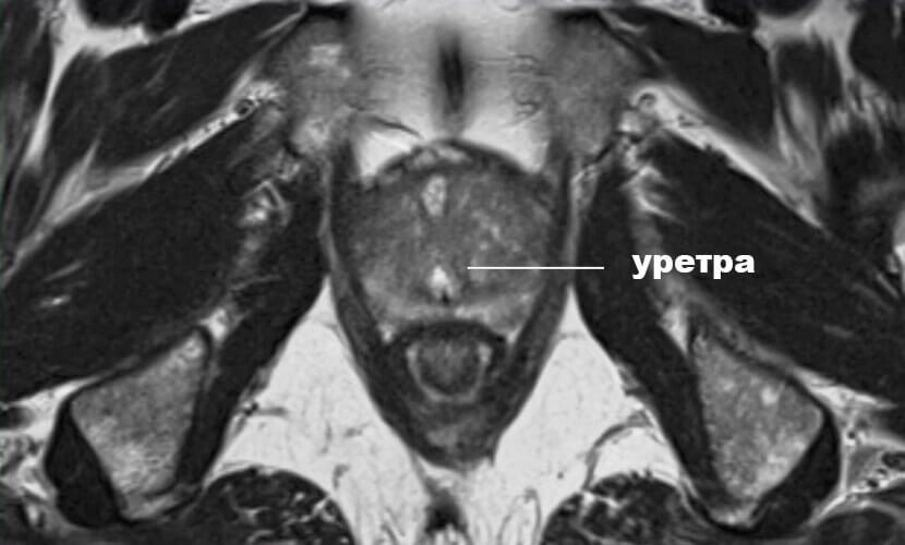 МРТ малого тазу у чоловіків (передміхурова залоза (простата), аденома простати) від компанії МРТ КТ Хмельницький Ультрадіагностіка - фото 1