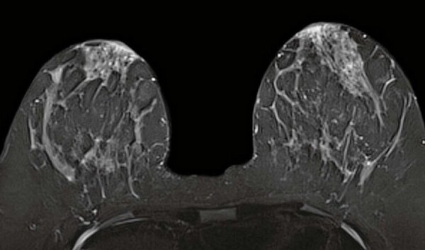 МРТ мамографія молочних залоз, грудей від компанії МРТ КТ Хмельницький Ультрадіагностіка - фото 1