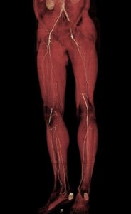 КТ-ангіографія нижніх кінцівок ніг, ноги