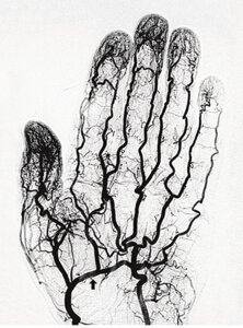 КТ-ангіографія верхніх кінцівок рук, руки