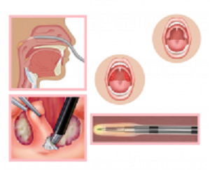 Коблація, ЛОР - хірургія, тонзилектомія, аденектомія, аденотомія